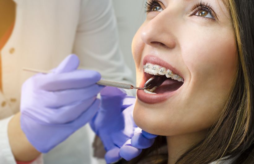 Beugels en orthodontie